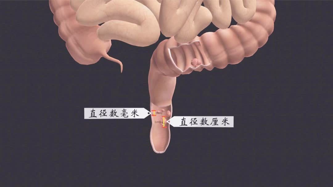 恶性胃肠息肉的治疗方法
