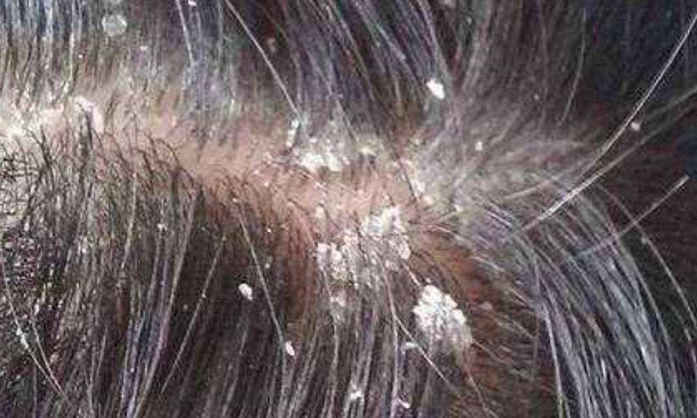 头止痒最有效的方法
