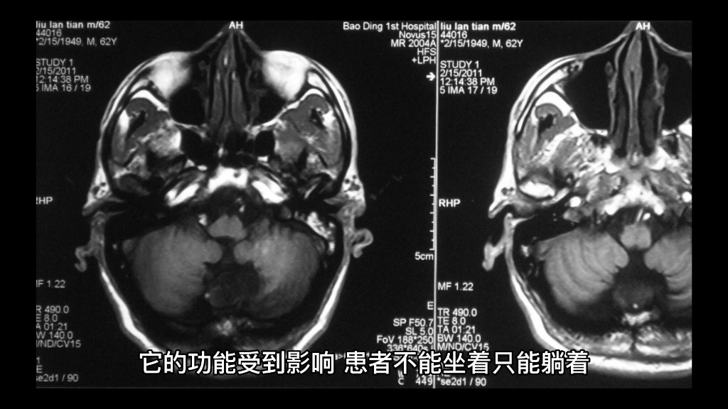 多系统萎缩包括小脑萎缩共济失调吗？