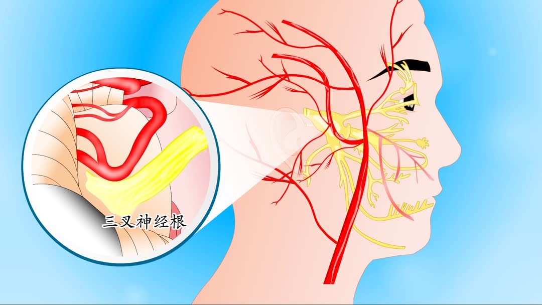 三叉神经痛主要病因是什么？怎么治疗三叉神经痛