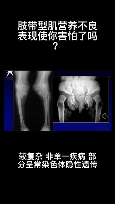 肢带型肌营养不良的治疗