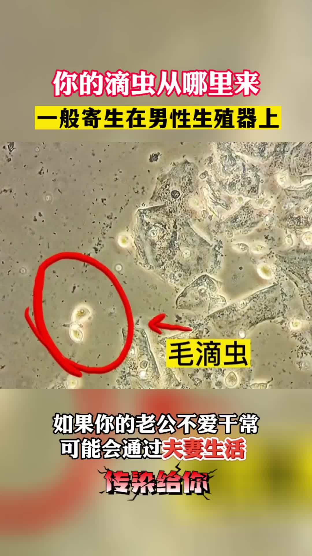 滴虫性阴炎怎么治疗