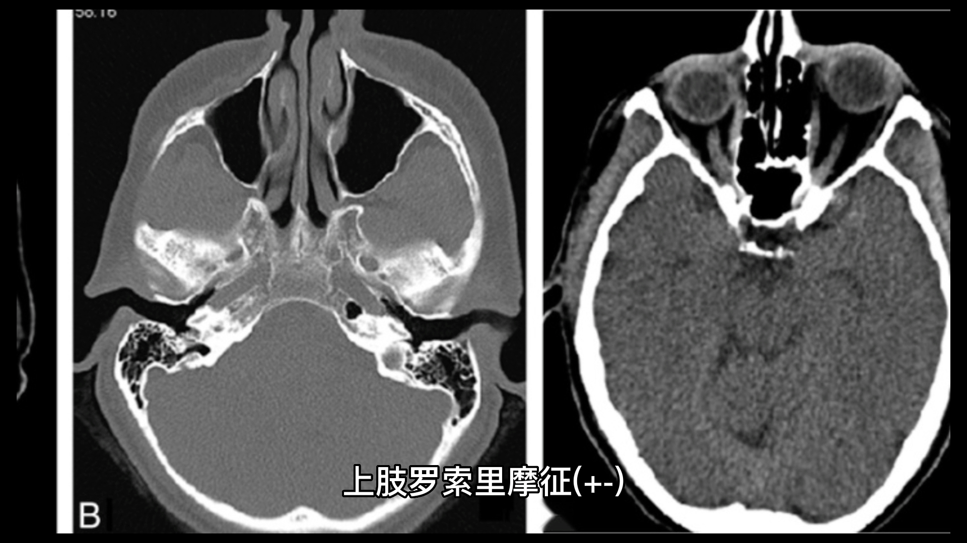 渐冻症患者的营养支持有哪些？