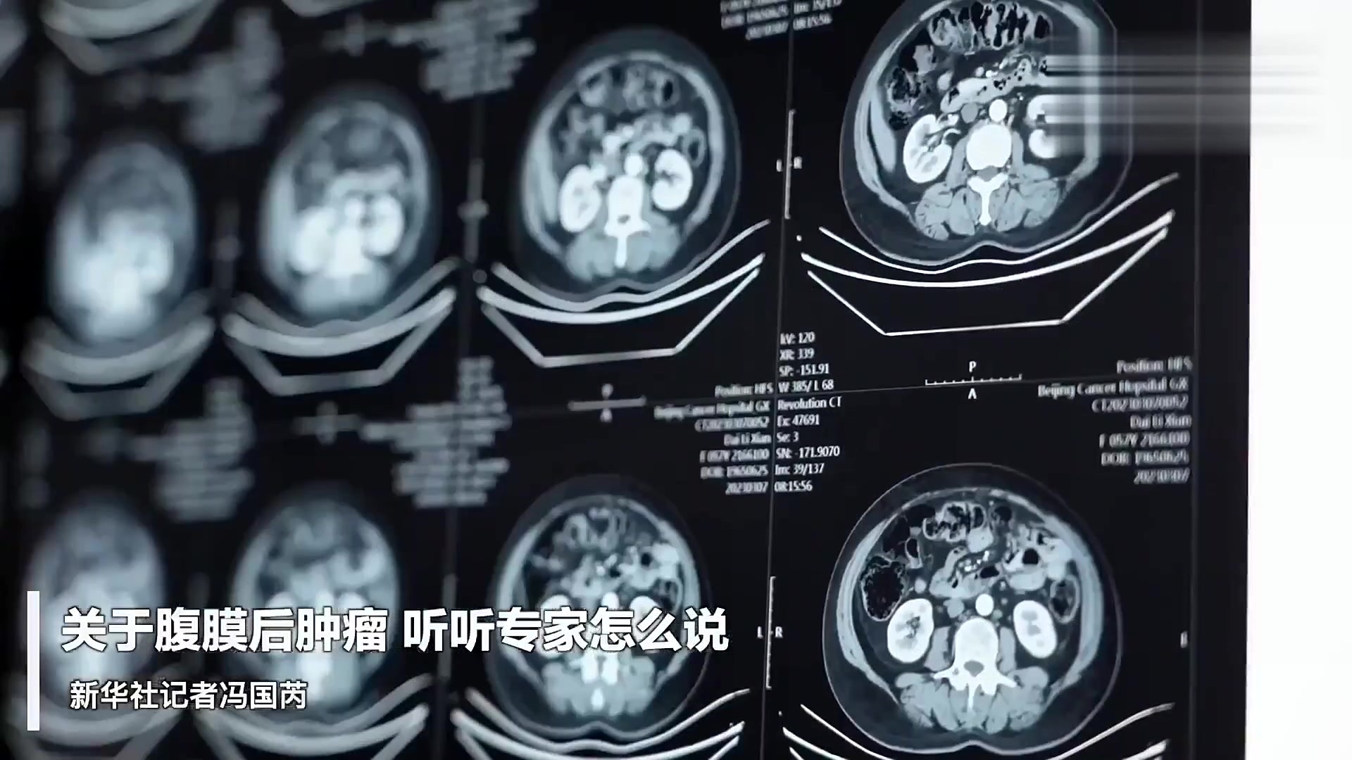 腹膜肿瘤如何治疗