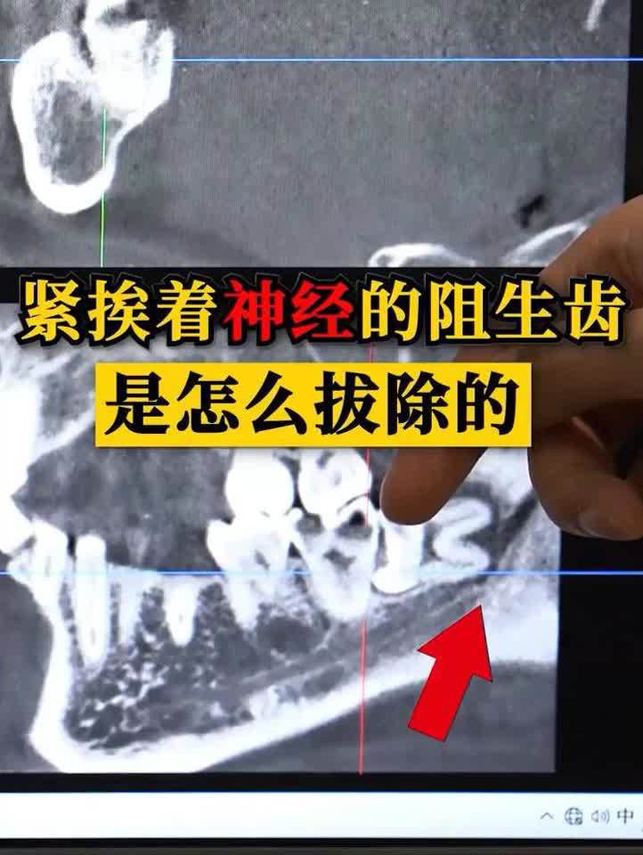 阻生齿拔了多久不痛(12/30)