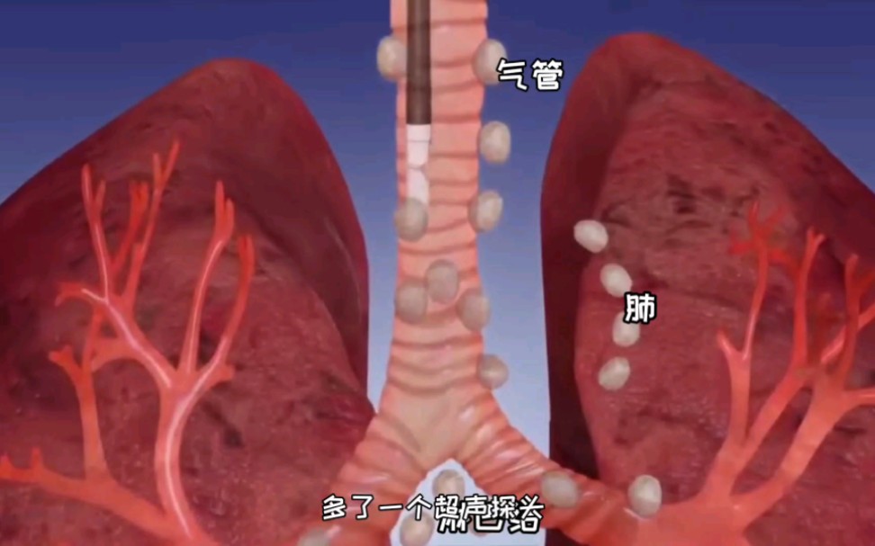 超声纤支镜是什么意思？