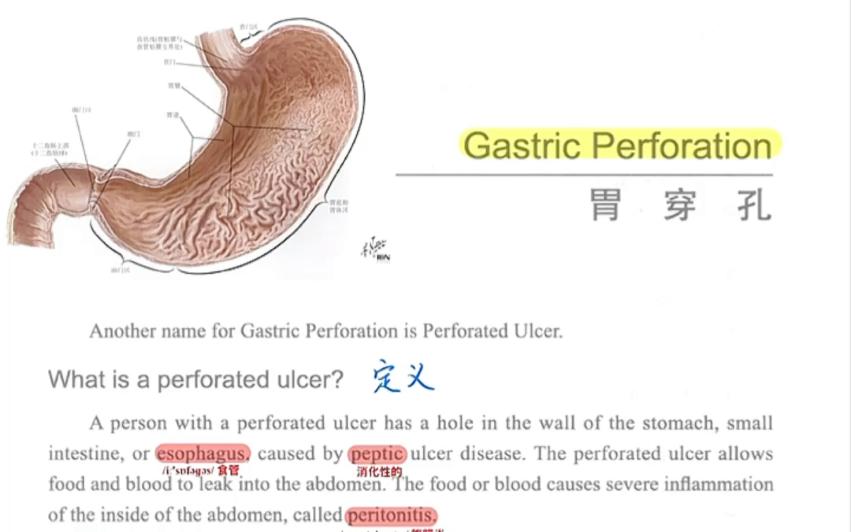 请问一下我今年25岁了我2009年胃穿孔动手术了