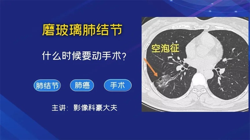 磨玻璃肺部结节是怎么回事