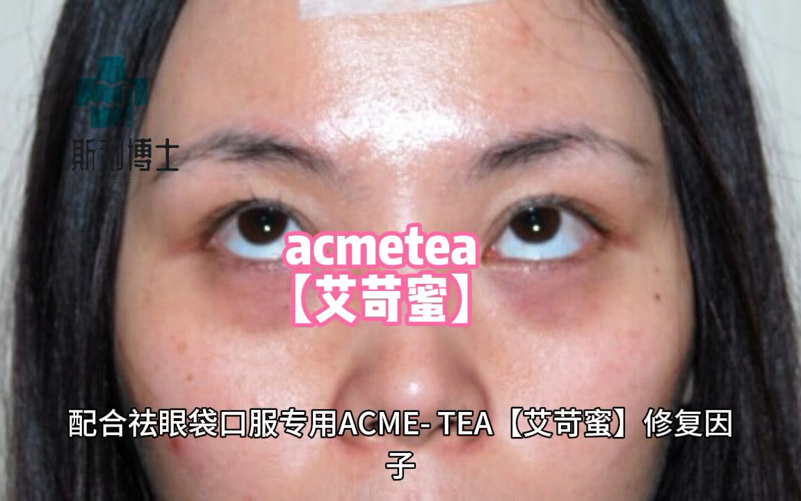 做去眼袋手术要花多少钱啊？