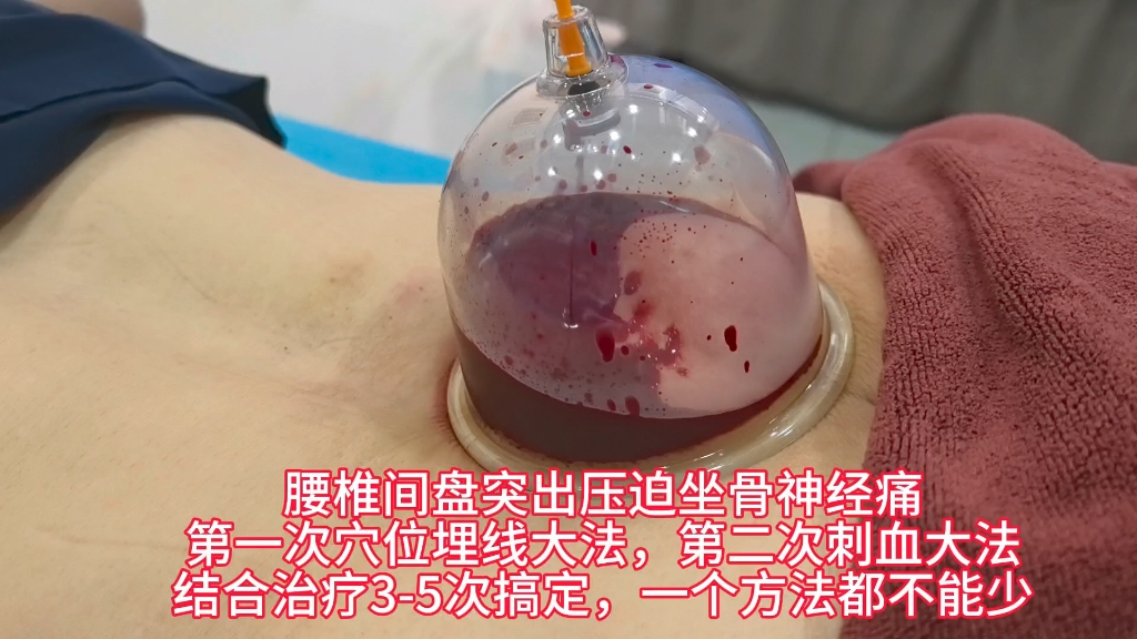 埋线治疗腰椎间盘突出(01/21)