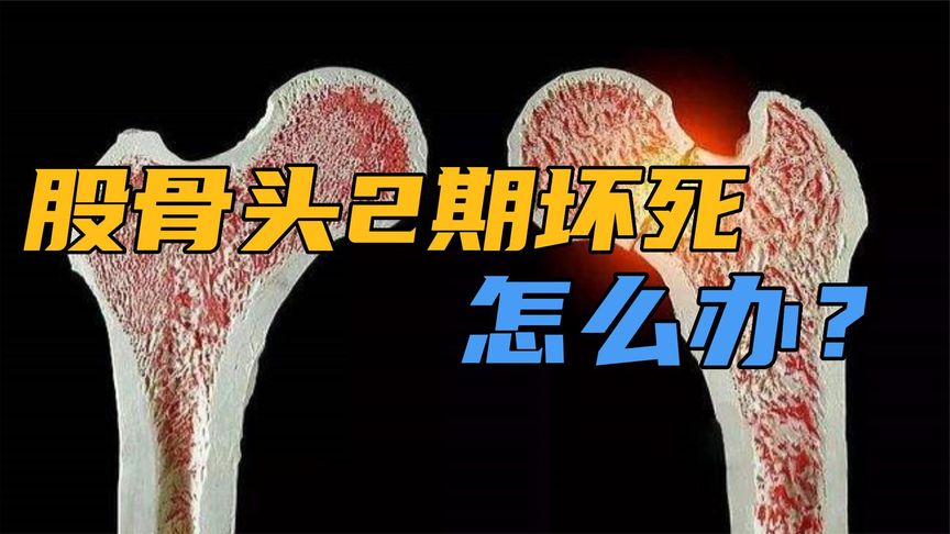 二期股骨头治疗(02/23更新)