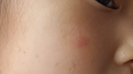 脸上长汗毛该吃什么药了
