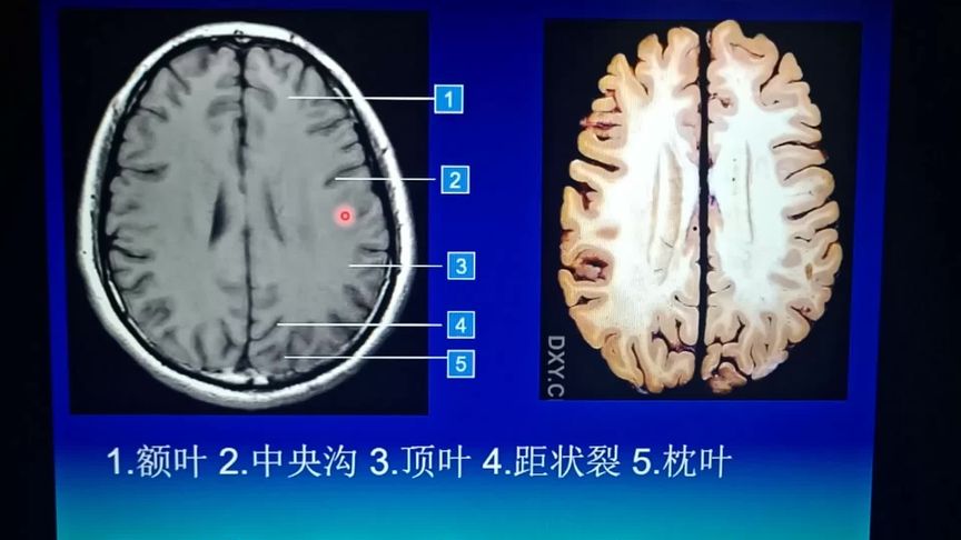 脑额叶缺血灶怎样治疗(03/01更新)