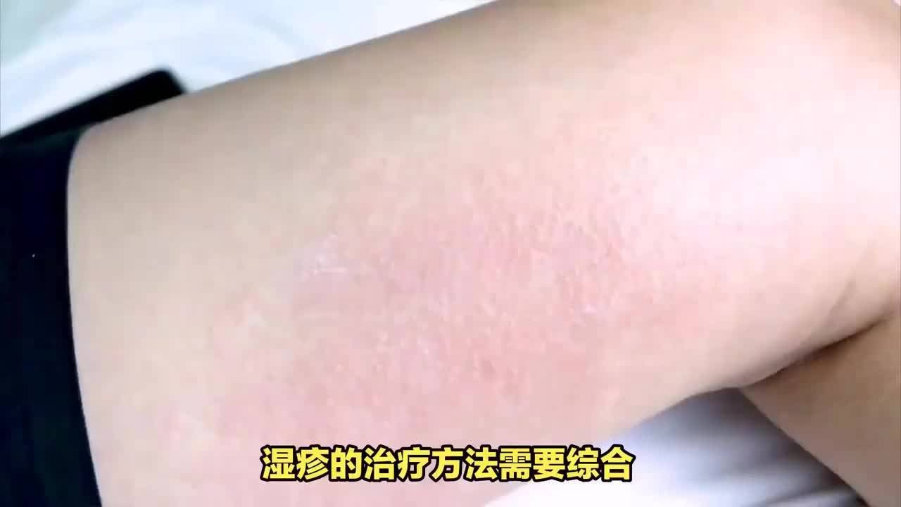 怎么治疗湿疹(01/02)