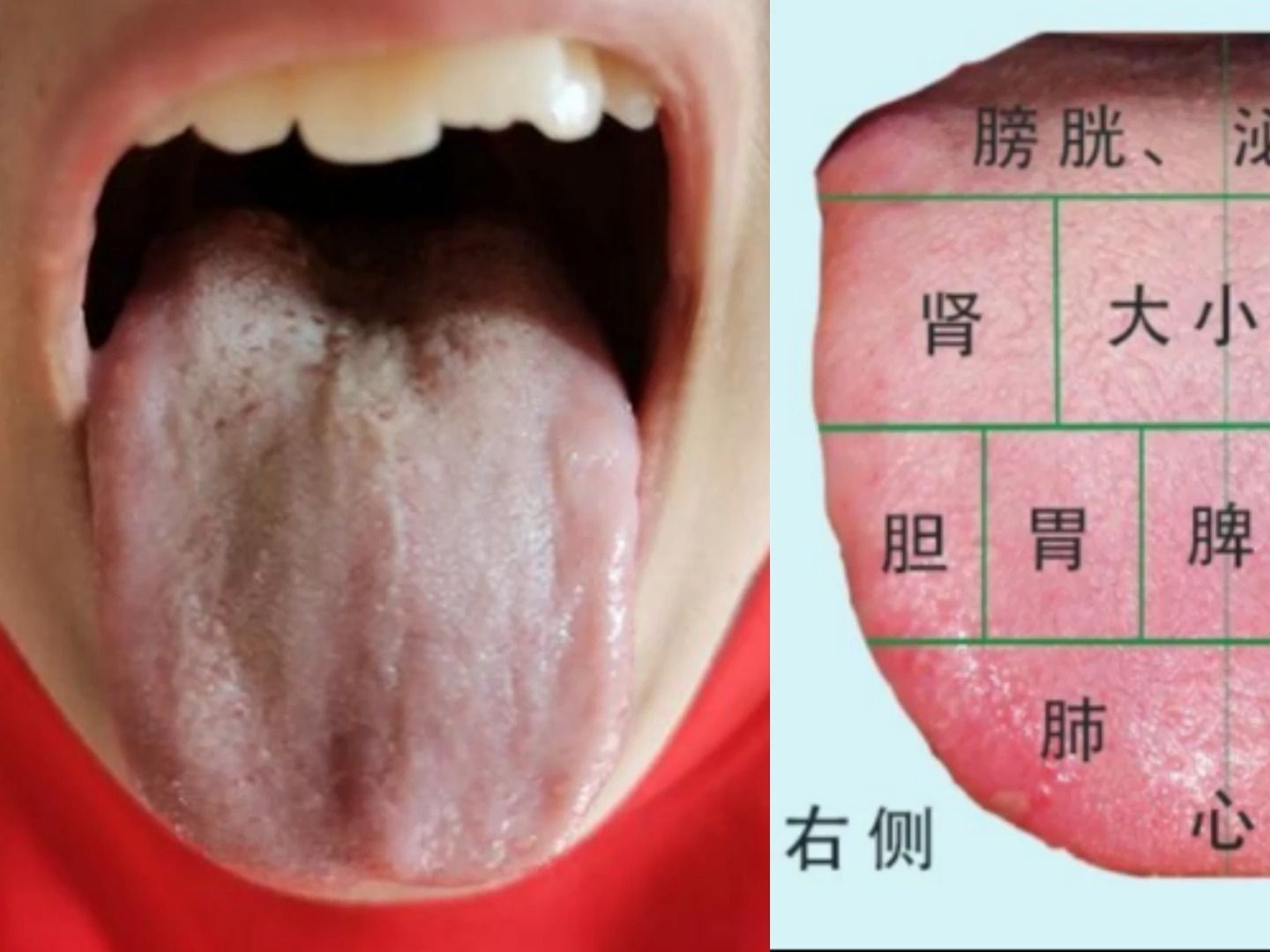 舌头溃疡10秒治愈方法