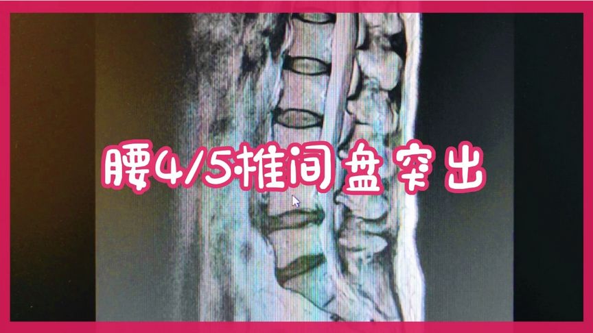 怎么治疗大脚趾外侧疼痛