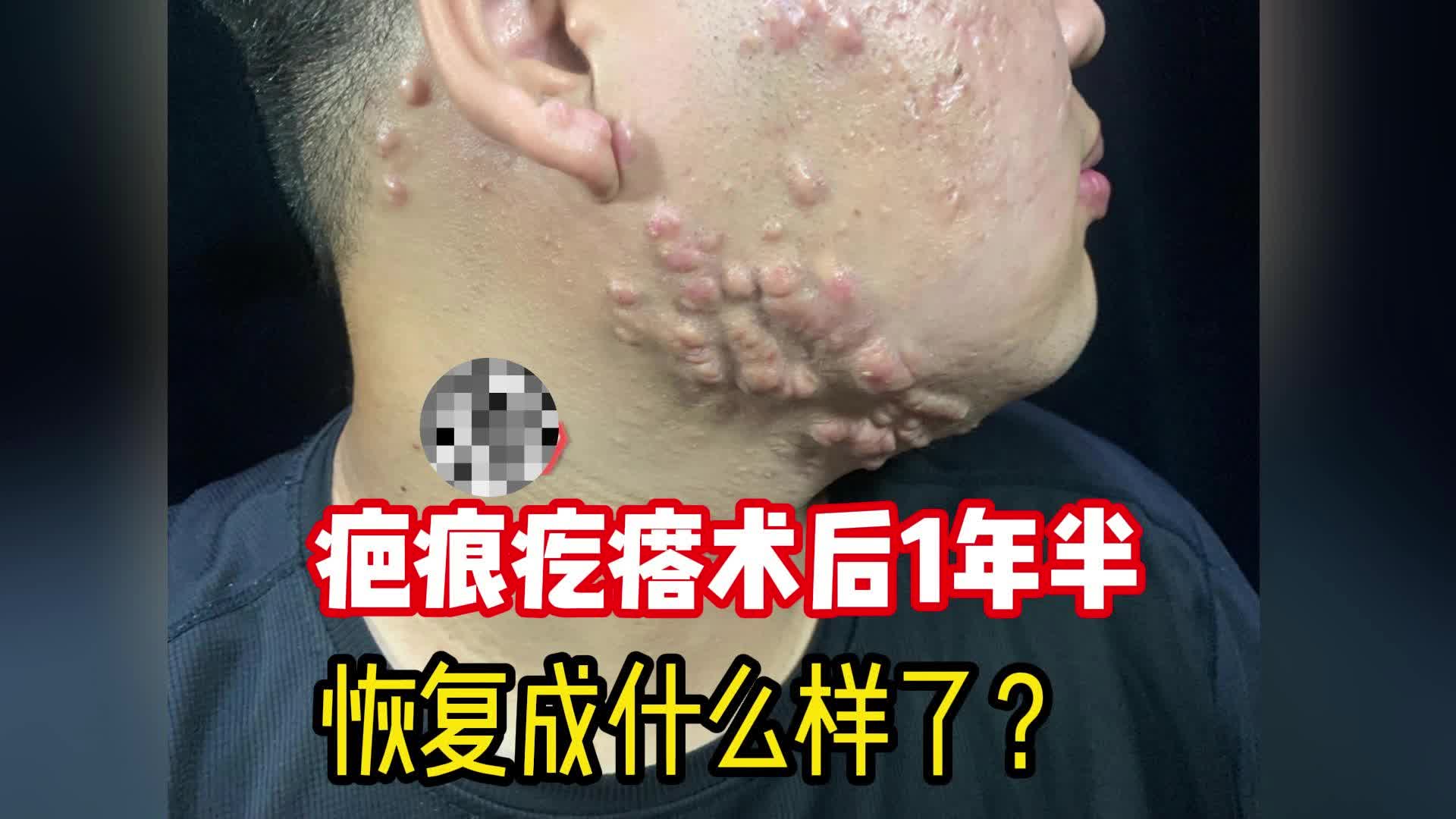 手术后留下的疤痕疙瘩怎样消