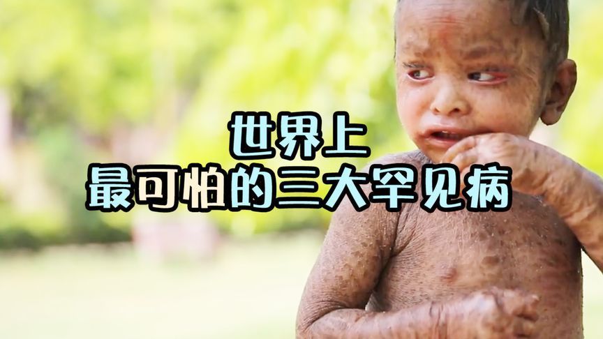 头上黑癣怎样治疗(头皮上长癣怎么治?)